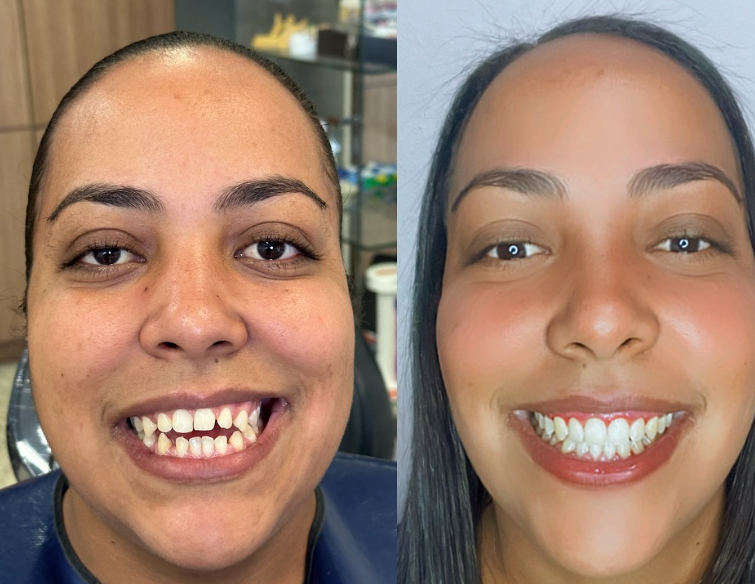 Antes e depois — procedimento 4